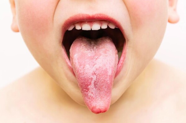 1 causes-of-an-adderall-tongue