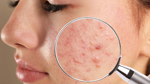 1 introduction-to-acne-scars