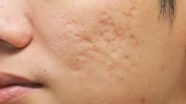 2 causes-of-single-acne-scar