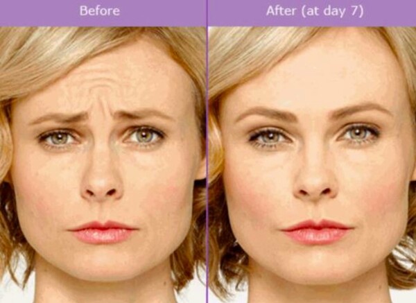 2 what-is-the-difference-between-botox-and-dysport
