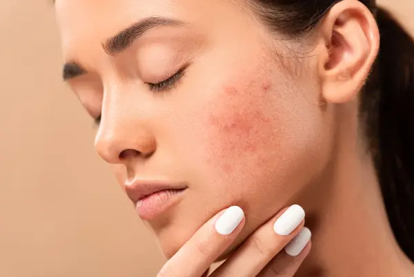 3 causes-of-acne-scars