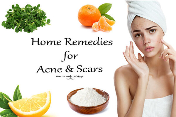 4 home-remedies-for-single-acne-scar