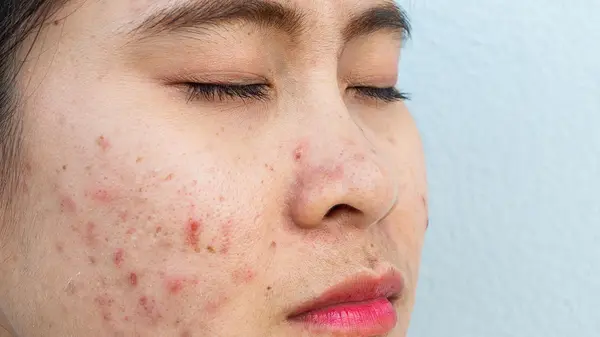 6 prevention-of-single-acne-scar