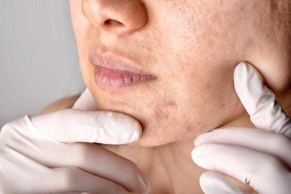 7 when-to-see-a-doctor-for-acne-scars