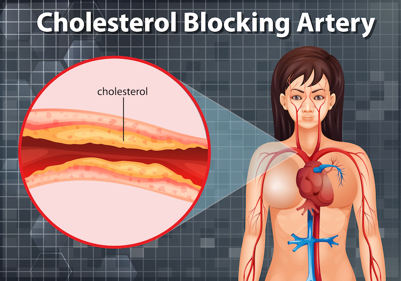 8 Food clean your arteries and can prevent a heart attack