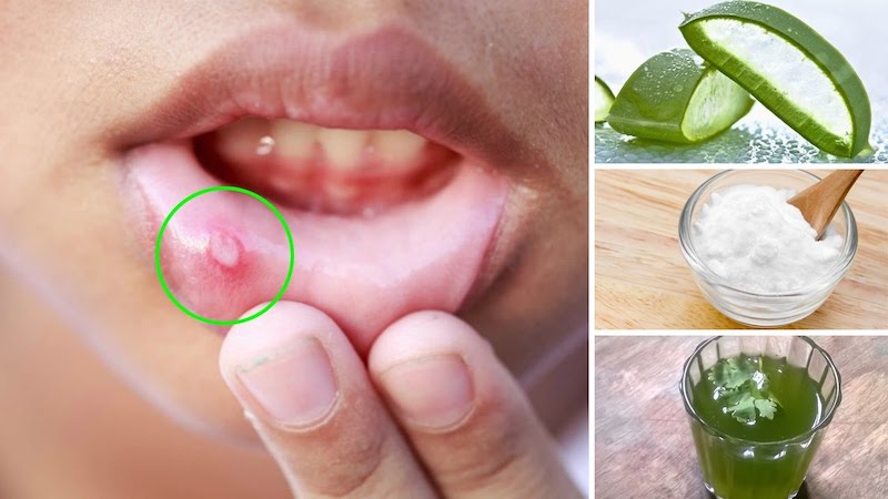 How to Get Rid of a Canker Sore Naturally at Home