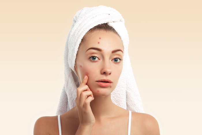 How to get rid of acne scars in 3 days