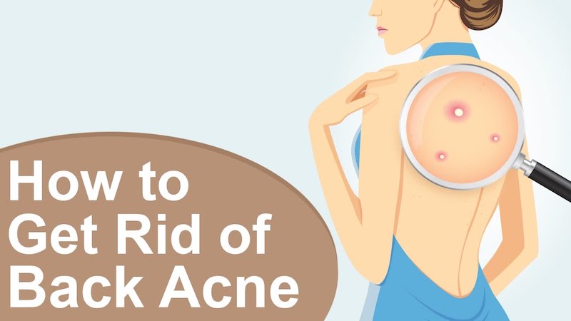 How to Get Rid of Back Acne Naturally at Home