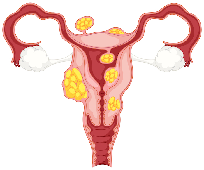 Ovarian cyst causes the top nutrients for ovarian cyst