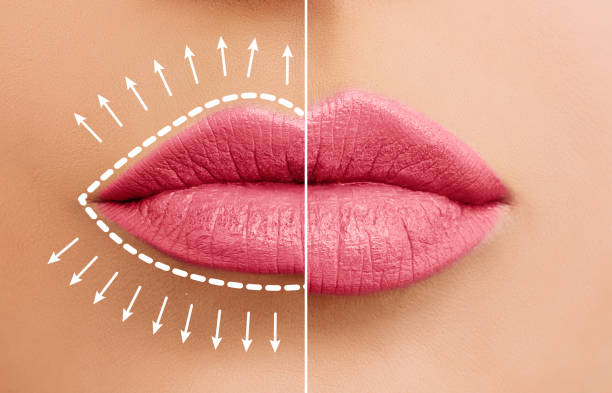 Transformative Elegance: Lip Filler Before and After for Thin Lips